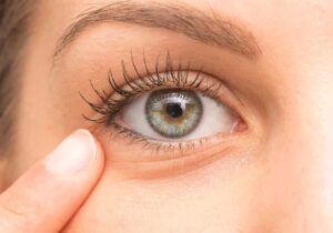 Göz Altı Morluk Giderme