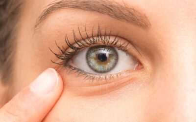 Göz Altı Morluk Giderme