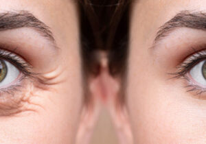 Göz Çevresi Estetiği