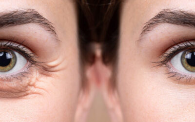 Göz Çevresi Estetiği